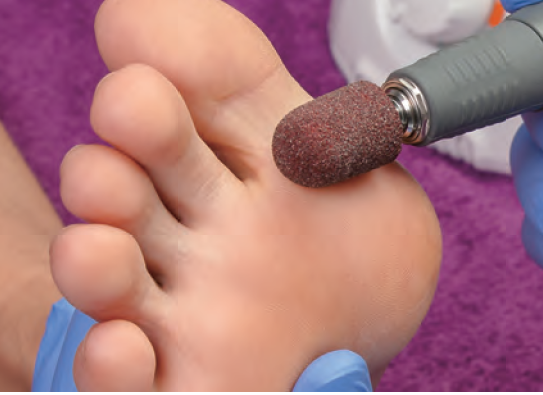 remove dead skin